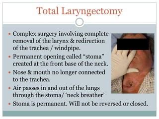total laryngectomy vula|Total Laryngectomy: A Review of Surgical Techniques .